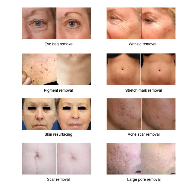 Fractional 4D CO2 Lase Scar Removal Machine 4D Fotona Co2 Fractional lase Machine Skin tightening Wrinkle Remover
