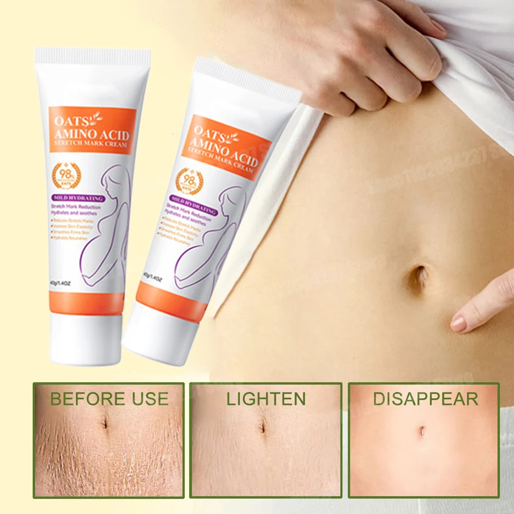 Stretch Marks Removal Cream Light Lines Postpartum Obesity Pregnancy Powerful Fast Absorption Main image