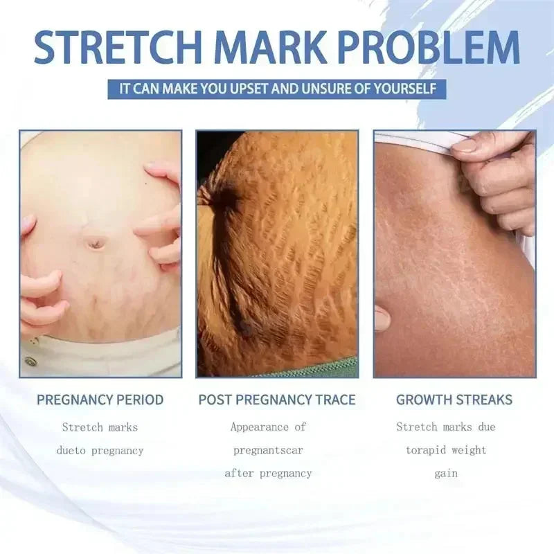 Stretch Marks Removal Cream Light Lines Postpartum Obesity Pregnancy Powerful Fast Absorption Secondary image