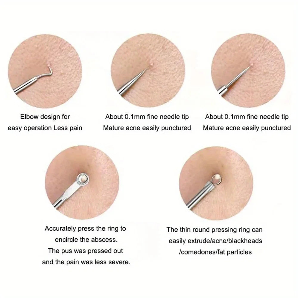 Blackhead Acne Pimple Blemish Extractor Remover Kit Stainless Steel Needles Remove Tools Face Skin Care Pore Cleaner 4pcs/bag Secondary image